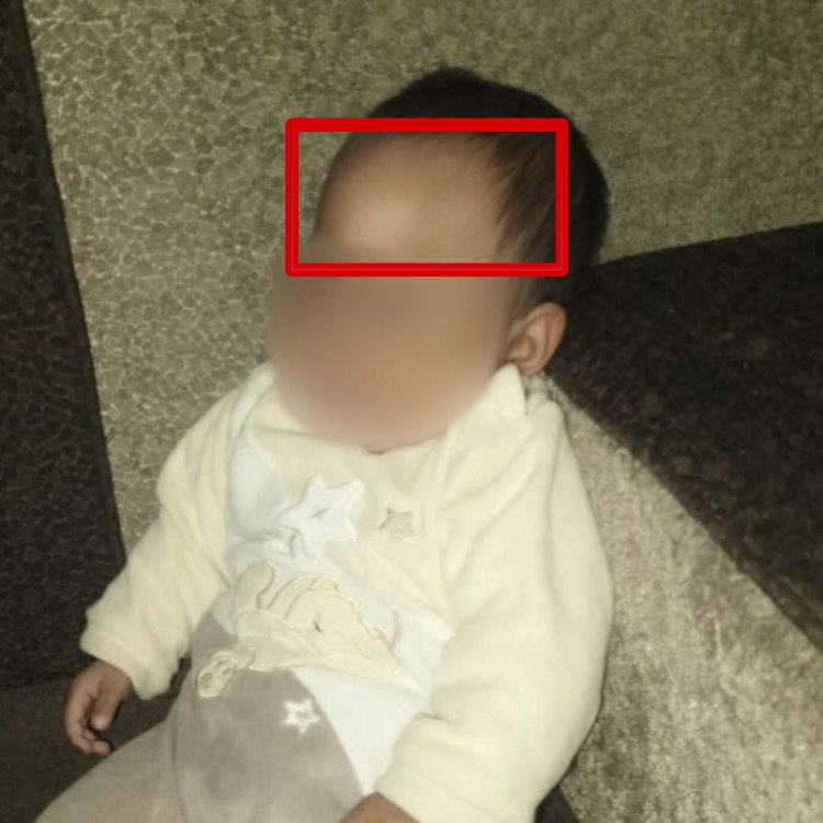 التحام الدرز الجبهي الباكر
