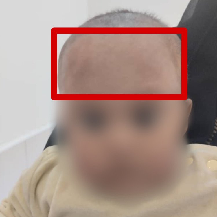 التحام الدرز الجبهي الباكر